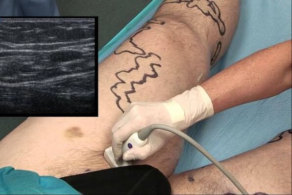 diagnosis varicose urat di lalaki