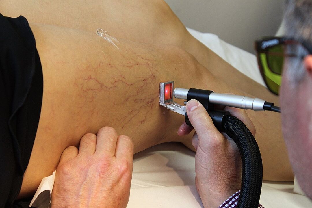Laser Choatululasi