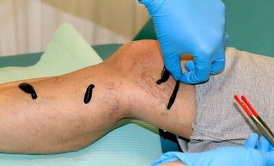 Hirsudotherapi pikeun urat variatif