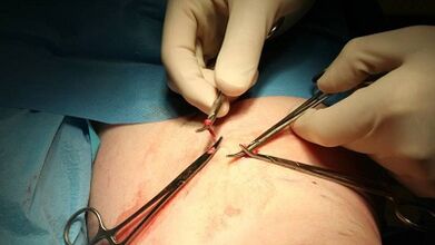 Flubectomy pikeun urat variatif