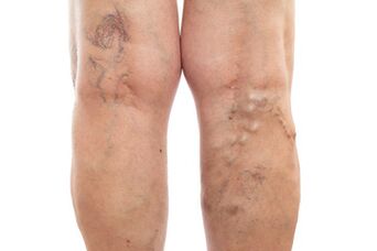 urat varicose tina extremities handap